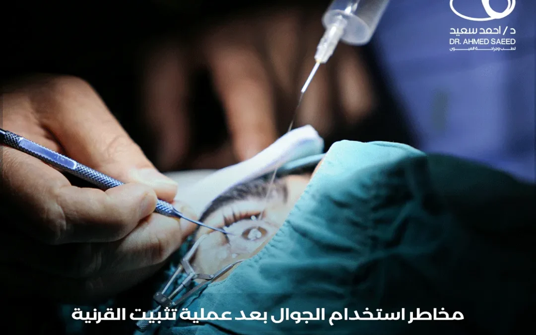 الجوال بعد عملية تثبيت القرنية