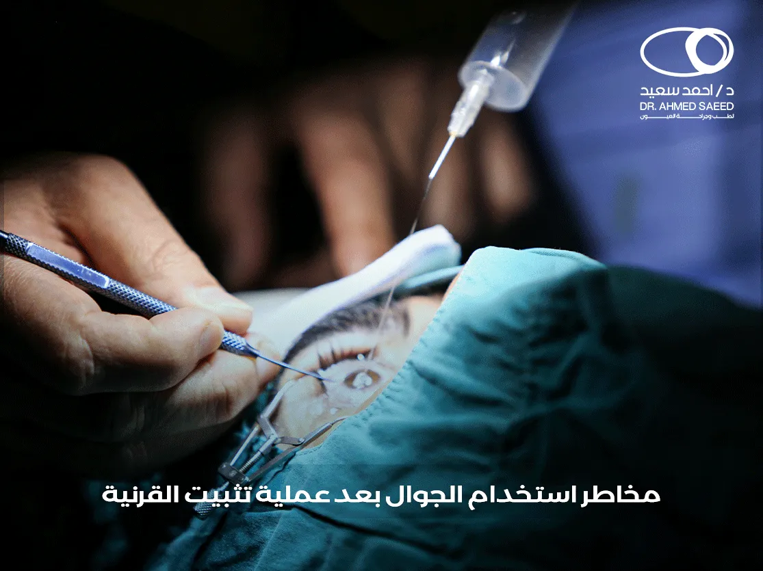 الجوال بعد عملية تثبيت القرنية