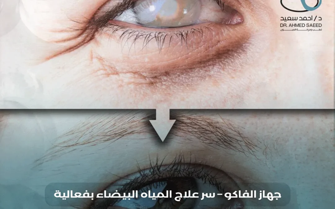 جهاز الفاكو للمياه البيضاء