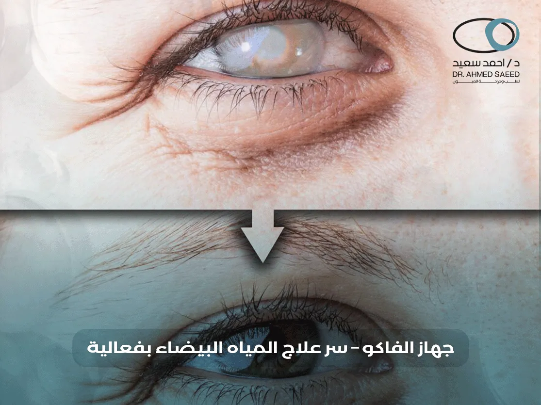 جهاز الفاكو للمياه البيضاء