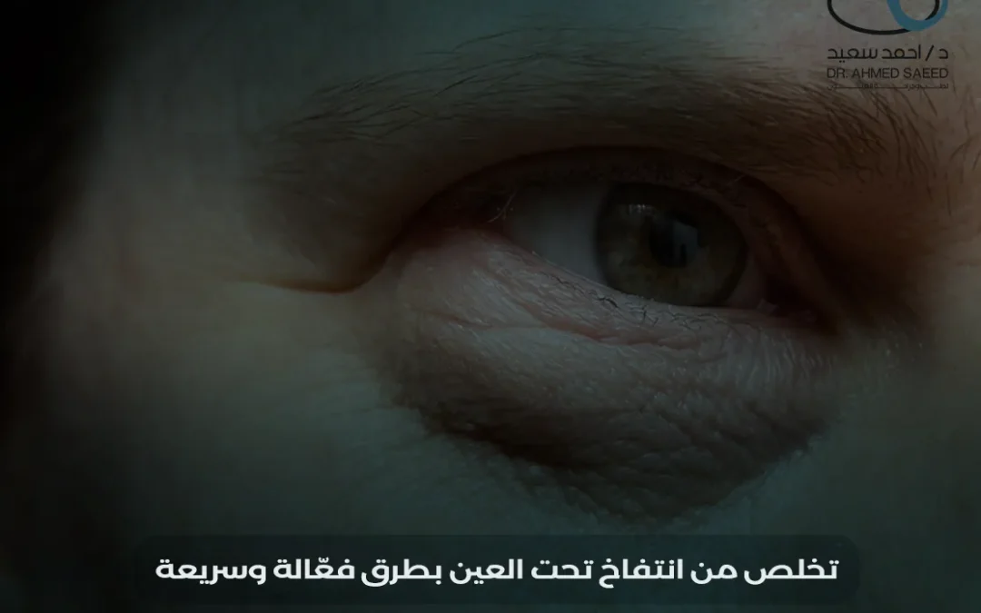 انتفاخ تحت العين