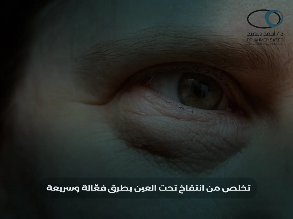 انتفاخ تحت العين انتفاخ تحت العين