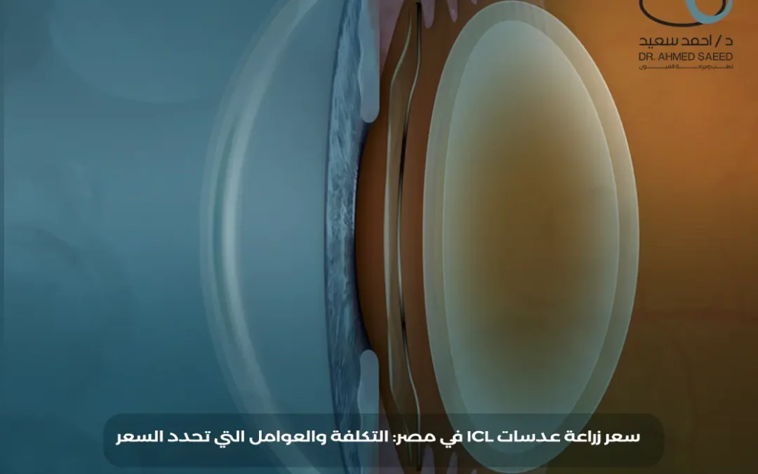 سعر زراعة عدسات ICL في مصر