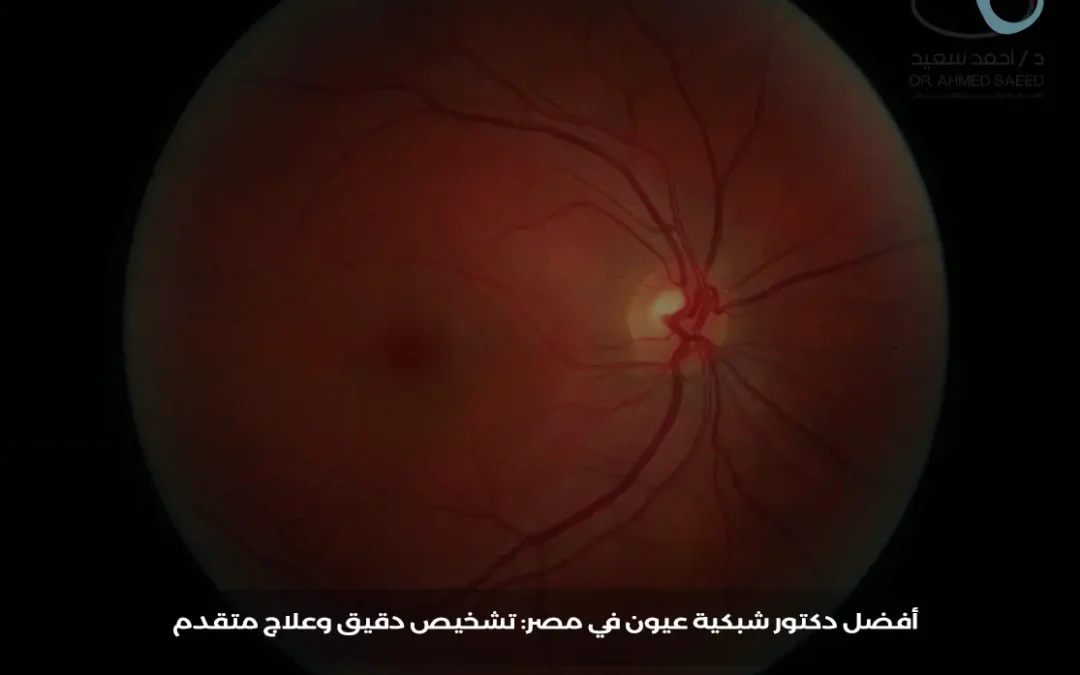أفضل دكتور شبكية عيون في مصر