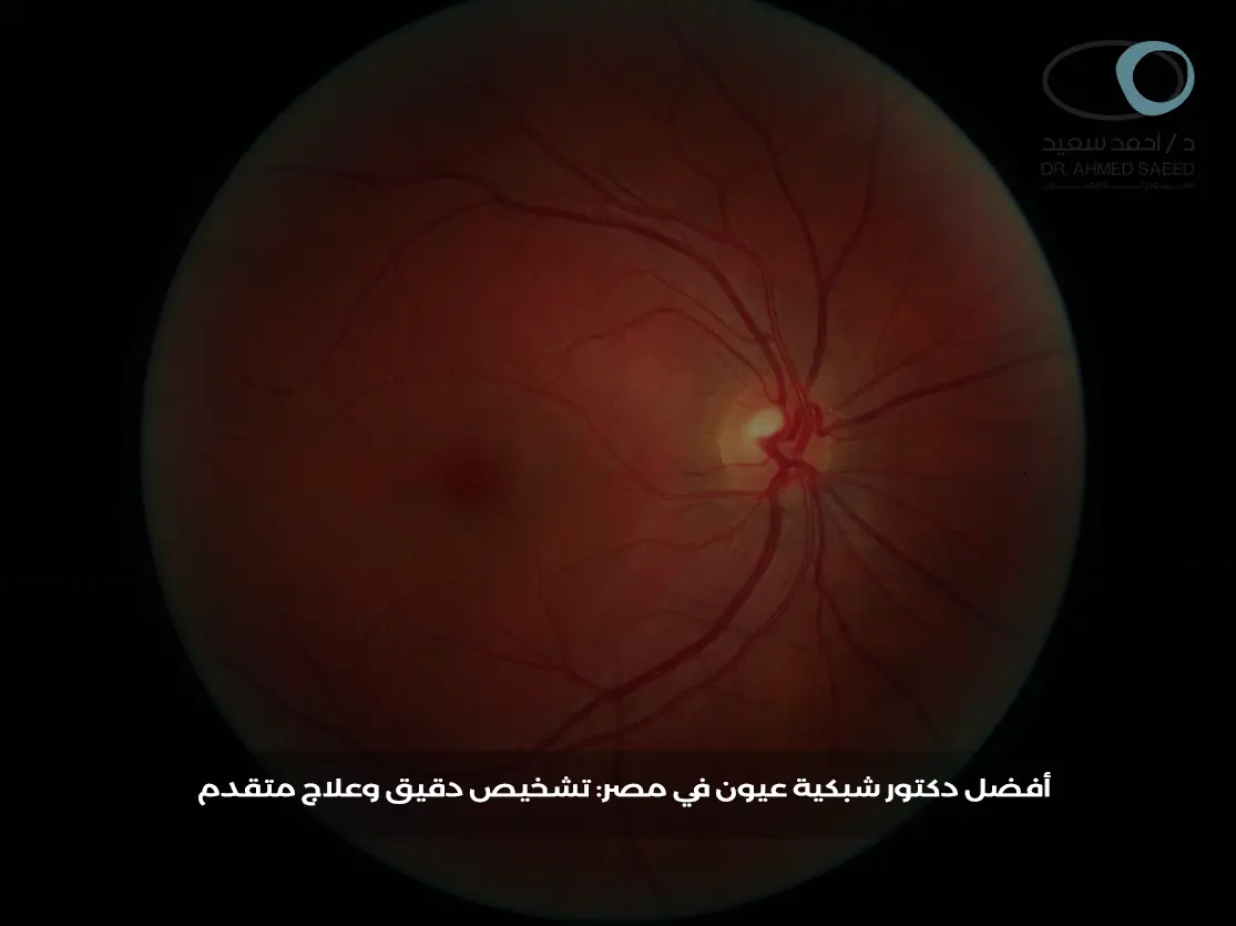 أفضل دكتور شبكية عيون في مصر