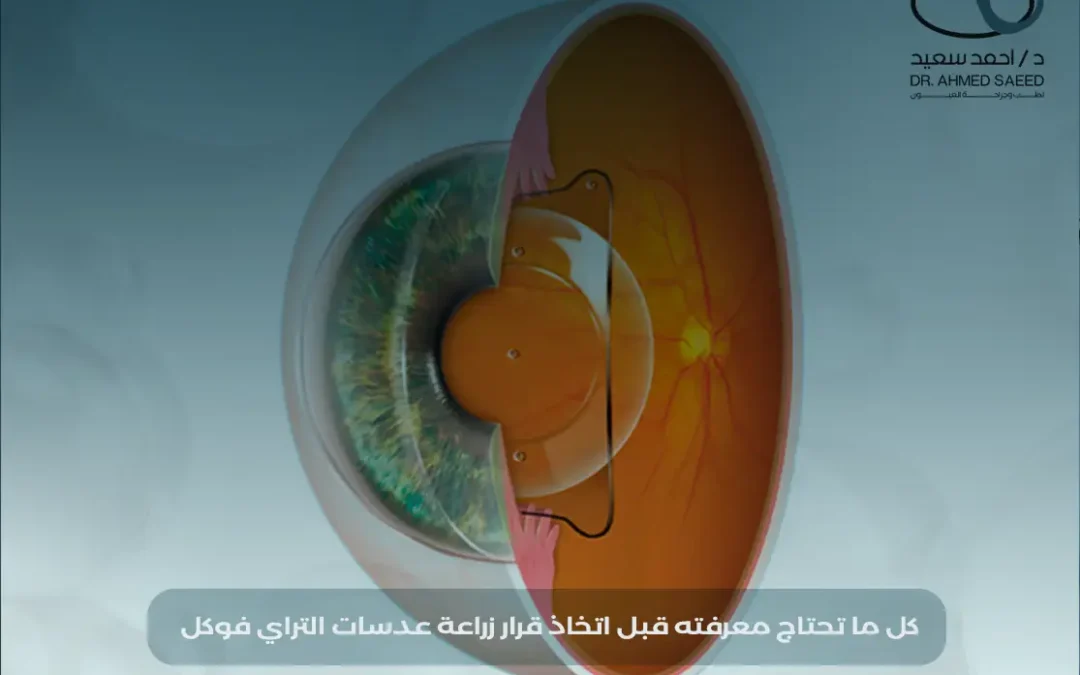 زراعة عدسات التراي فوكل