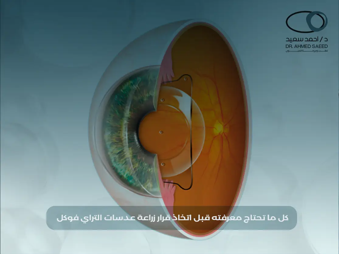 زراعة عدسات التراي فوكل