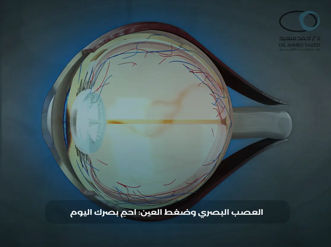 العلاقة بين العصب البصري وضغط العين العلاقة بين العصب البصري وضغط العين