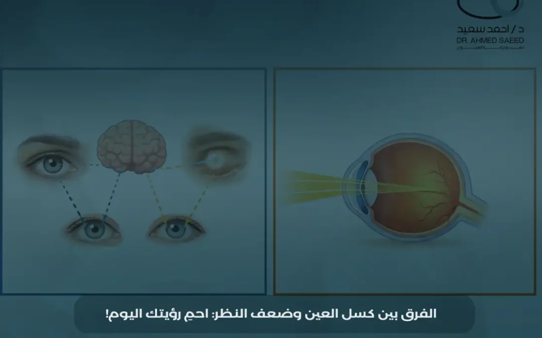 الفرق بين كسل العين وضعف النظر