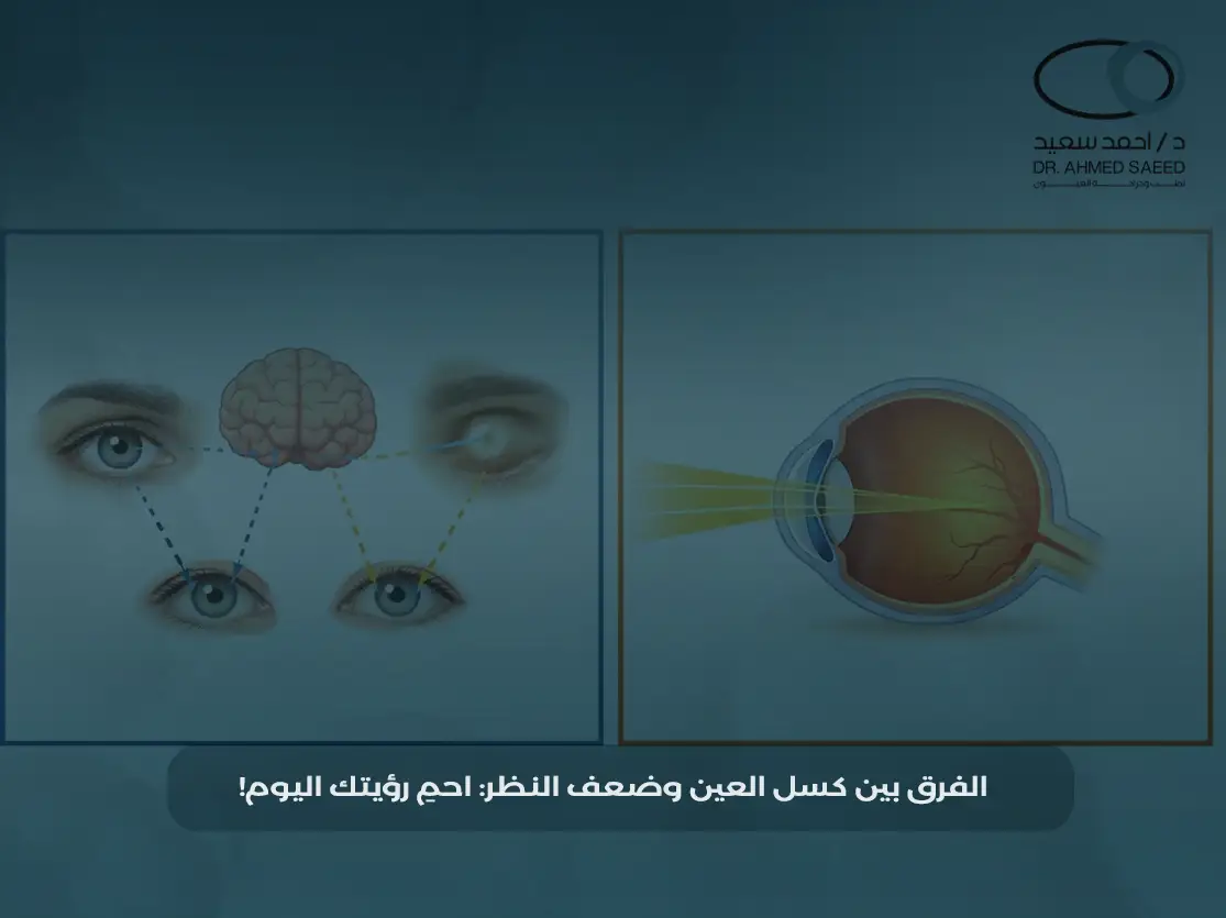 الفرق بين كسل العين وضعف النظر الفرق بين كسل العين وضعف النظر