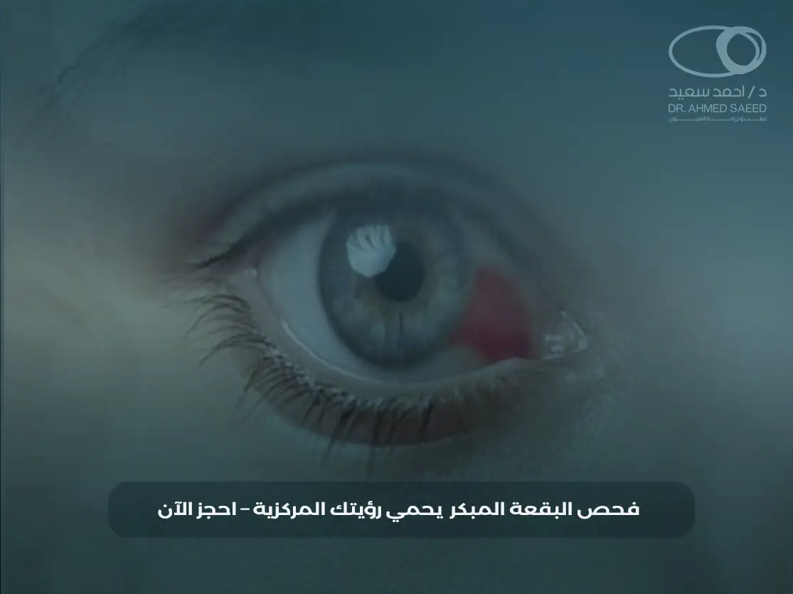 علاج تنكس البقعة العمري في مصر