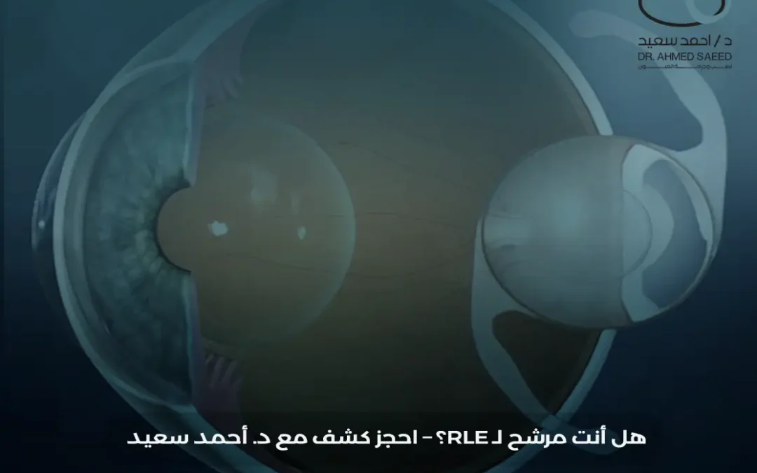 عملية استبدال العدسة الشفافة RLE