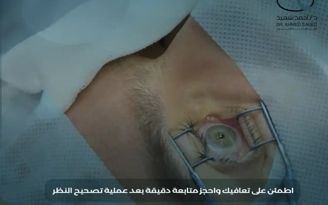 متى تظهر نتيجة عملية تصحيح النظر؟ دليل شامل للتعافي وما تتوقعه بعد العملية