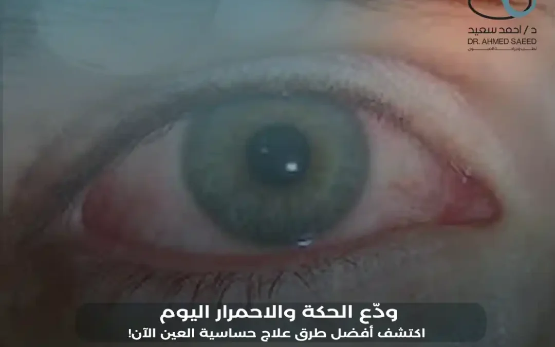 أفضل طرق علاج حساسية العين بفعالية وأمان في 2026