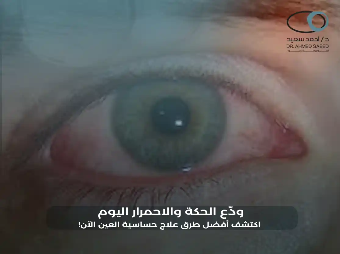 طرق علاج حساسية العين