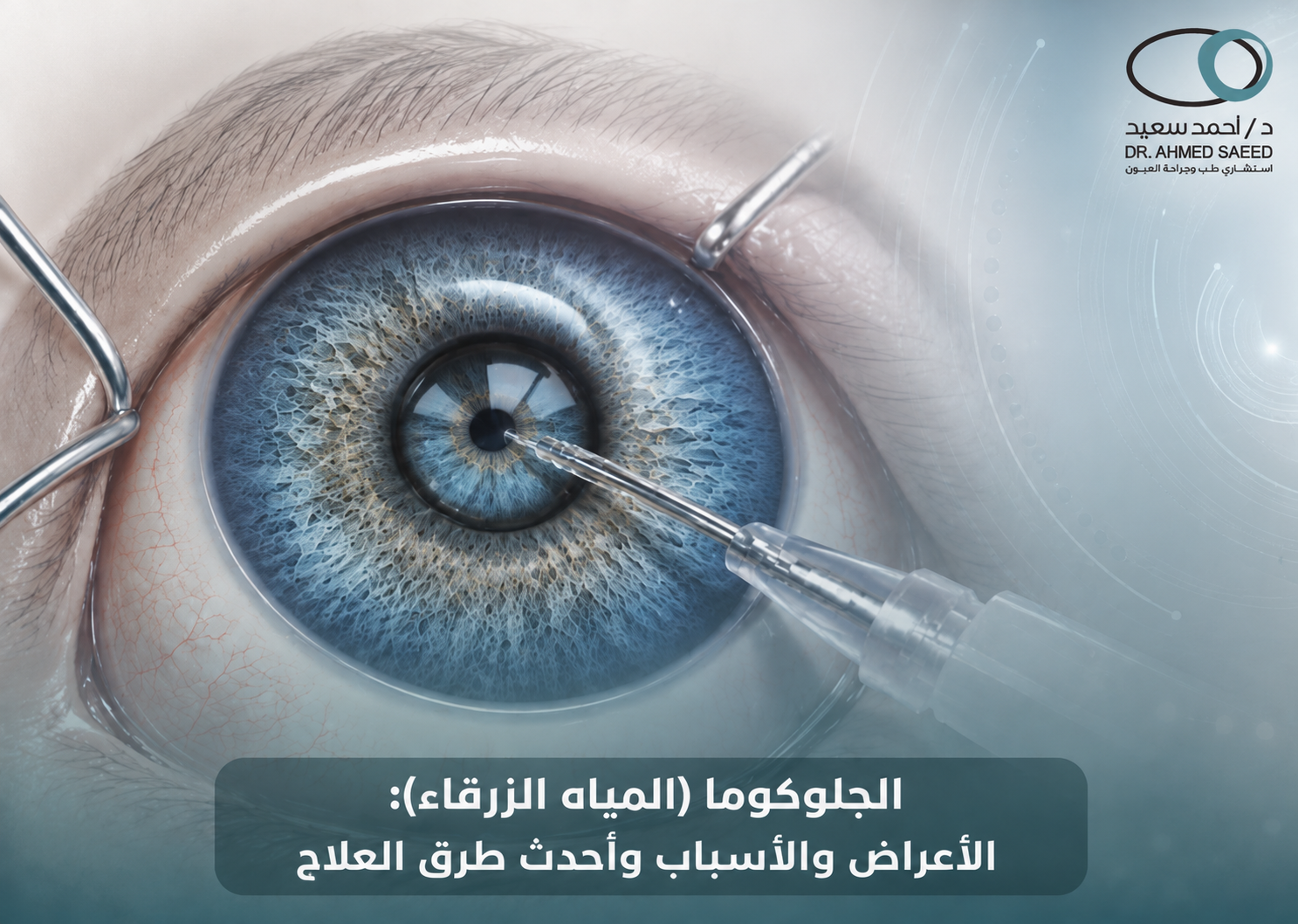 المياه الزرقاء الجلوكوما
