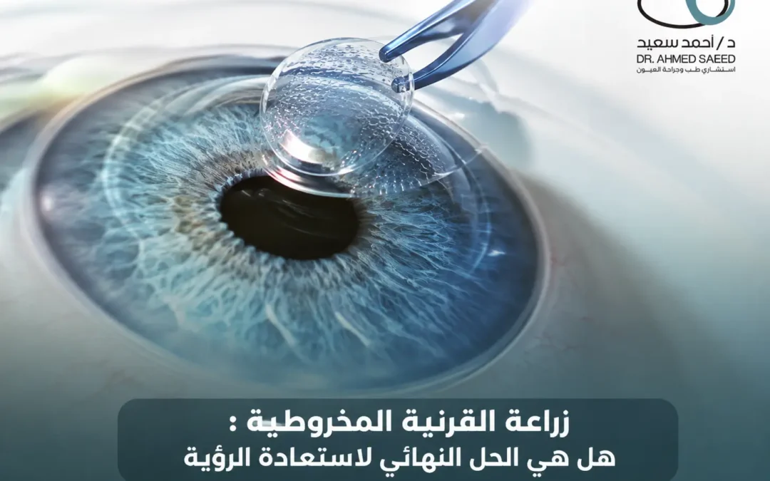 زراعة القرنية المخروطية : هل هي الحل النهائي لاستعادة الرؤية