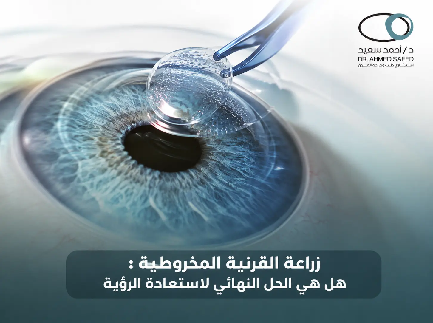 زراعة القرنية المخروطية هل هي الحل النهائي لاستعادة الرؤية