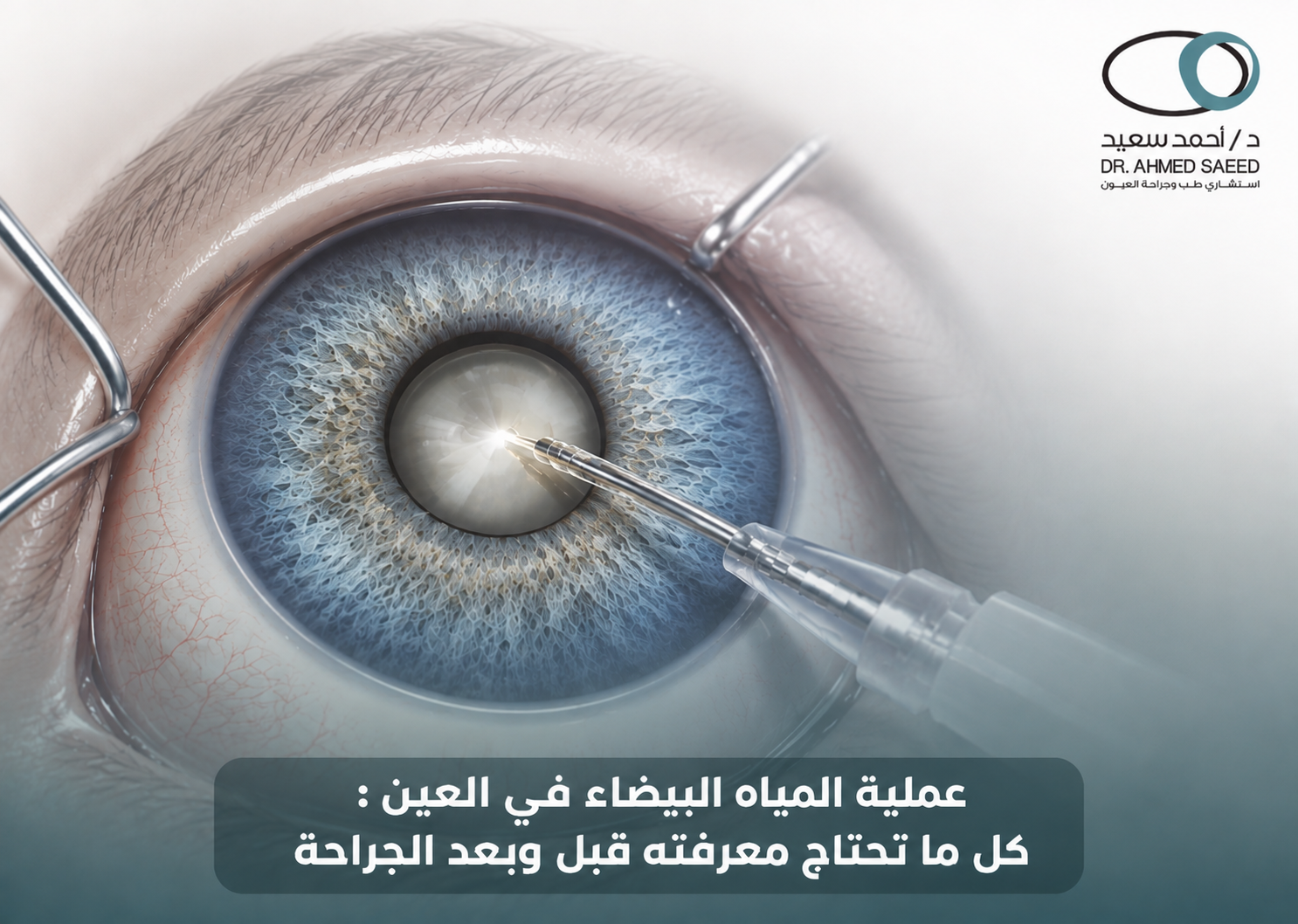عملية المياه البيضاء في العين كل ما تحتاج معرفته قبل وبعد الجراحة