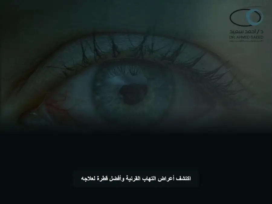 التهاب القرنية - الأعراض وأفضل قطرة للعلاج